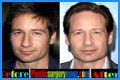 David Duchovny Plastic Surgery Before and After