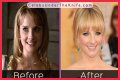 Melissa Rauch Plastic Surgery Before and After